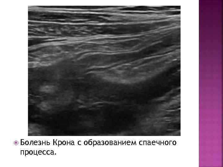  Болезнь Крона с образованием спаечного процесса. 