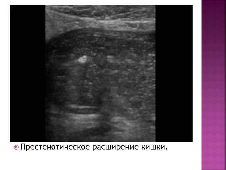  Престенотическое расширение кишки. 