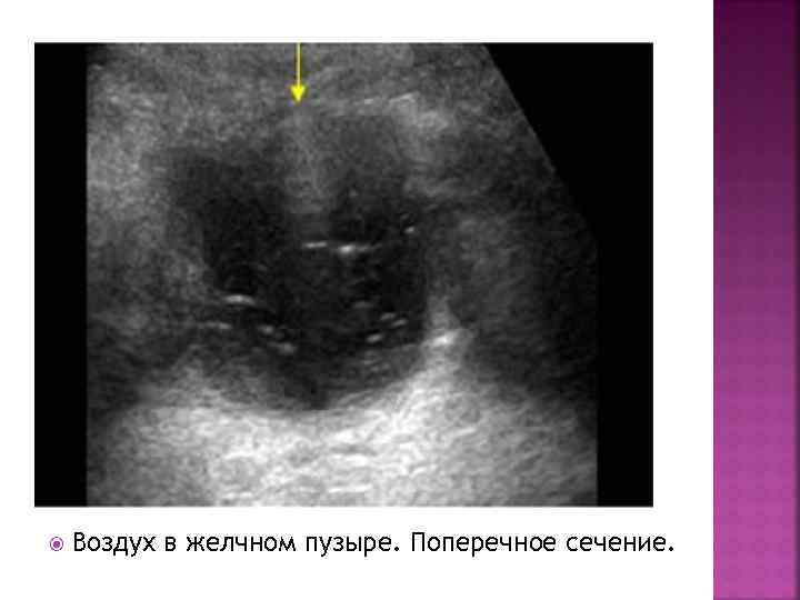  Воздух в желчном пузыре. Поперечное сечение. 