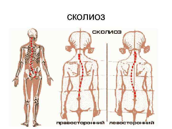 сколиоз 