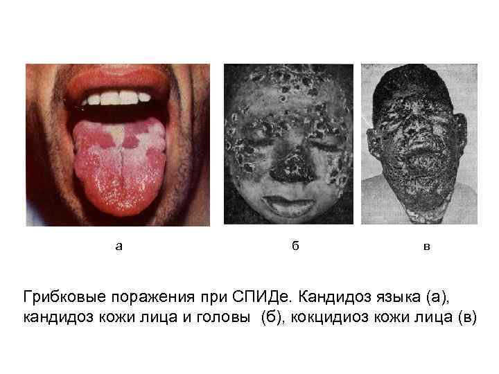 а б в Грибковые поражения при СПИДе. Кандидоз языка (а), кандидоз кожи лица и