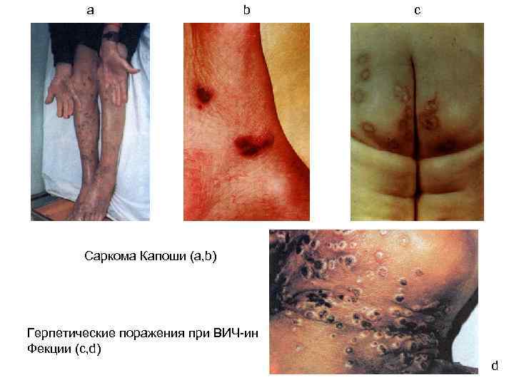 a b c Саркома Капоши (a, b) Герпетические поражения при ВИЧ-ин Фекции (c, d)