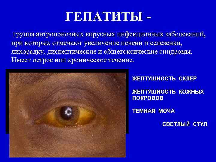 ГЕПАТИТЫ группа антропонозных вирусных инфекционных заболеваний, при которых отмечают увеличение печени и селезенки, лихорадку,