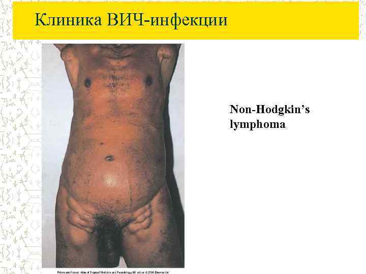 Клиника ВИЧ-инфекции Non-Hodgkin’s lymphoma 
