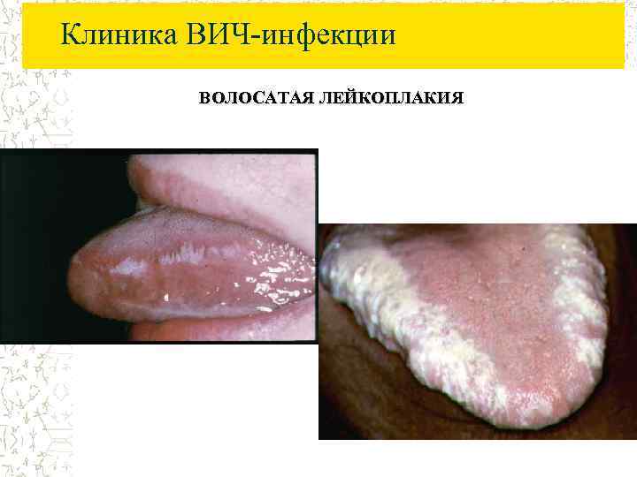Клиника ВИЧ-инфекции ВОЛОСАТАЯ ЛЕЙКОПЛАКИЯ 