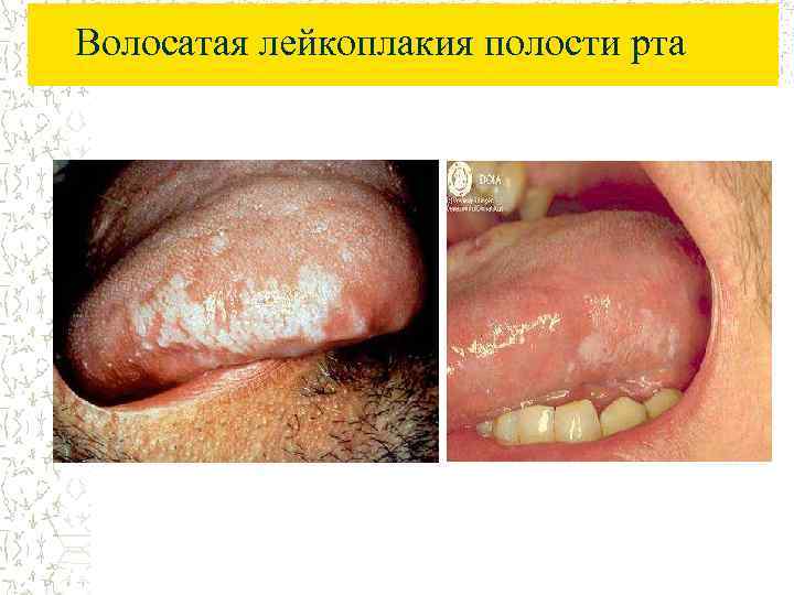 Волосатая лейкоплакия полости рта 