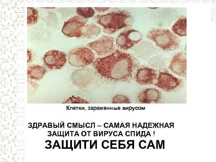 Клетки, зараженные вирусом ЗДРАВЫЙ СМЫСЛ – САМАЯ НАДЕЖНАЯ ЗАЩИТА ОТ ВИРУСА СПИДА ! ЗАЩИТИ