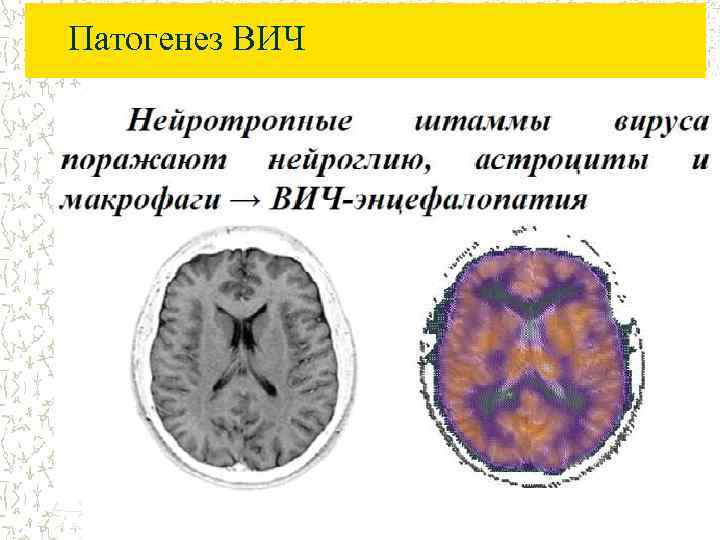 Патогенез ВИЧ 