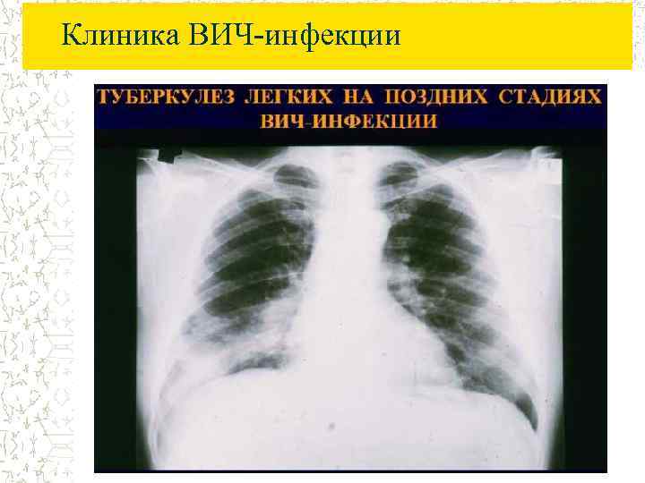 Клиника ВИЧ-инфекции 