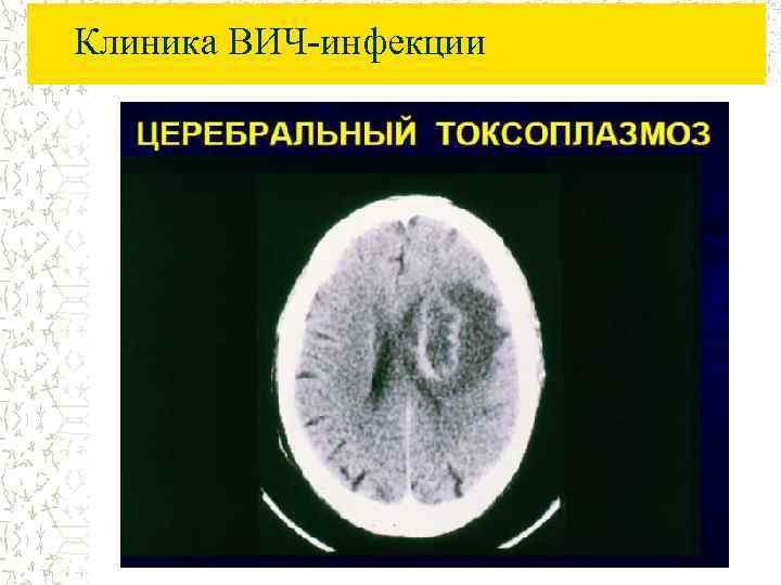 Клиника ВИЧ-инфекции 