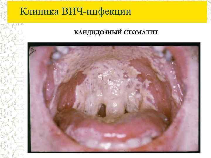 Клиника ВИЧ-инфекции КАНДИДОЗНЫЙ СТОМАТИТ 