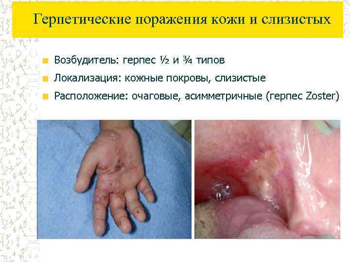 Герпетические поражения кожи и слизистых Возбудитель: герпес ½ и ¾ типов Локализация: кожные покровы,