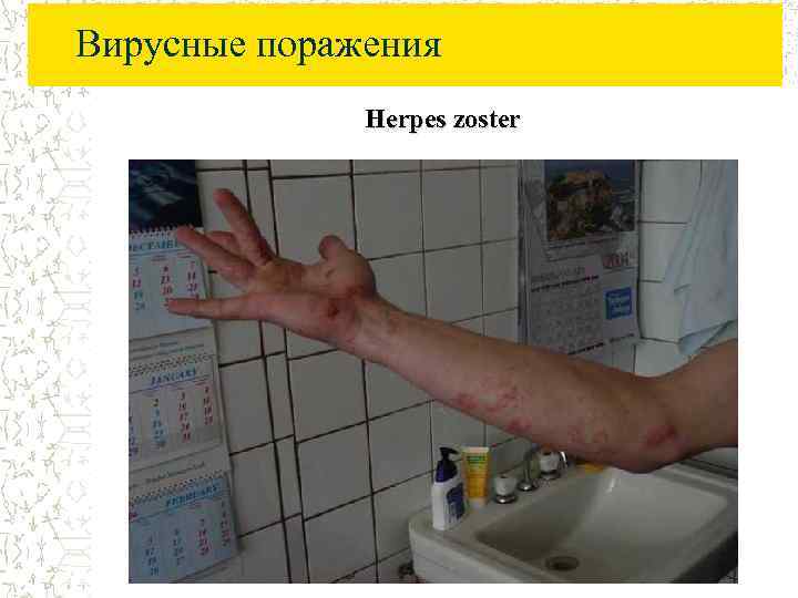 Вирусные поражения Herpes zoster 
