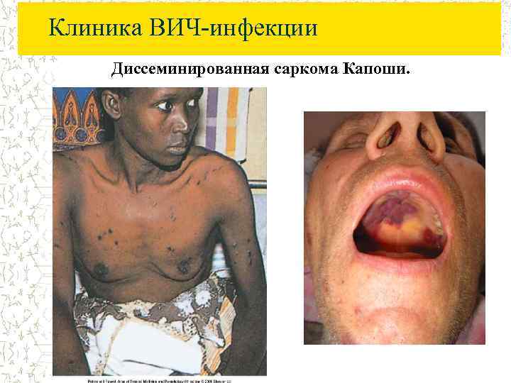 Клиника ВИЧ-инфекции Диссеминированная саркома Капоши. 