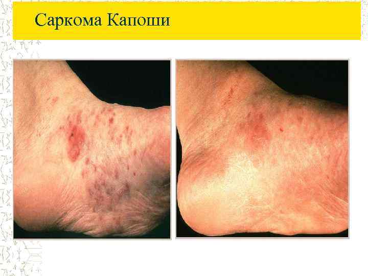 Саркома Капоши 