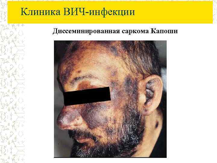 Клиника ВИЧ-инфекции Диссеминированная саркома Капоши 