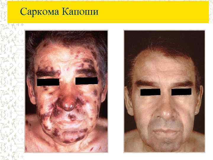 Саркома Капоши 