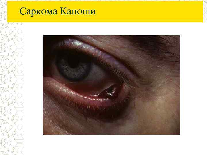 Саркома Капоши 