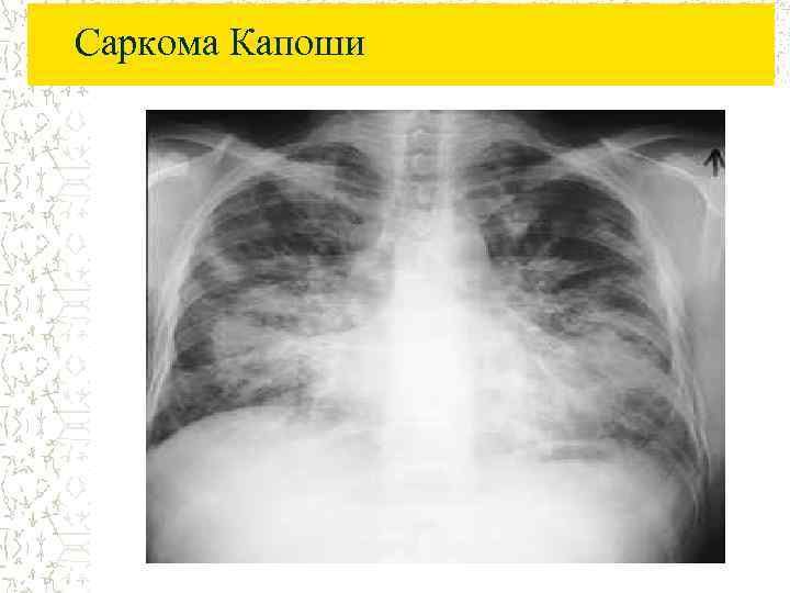 Саркома Капоши 