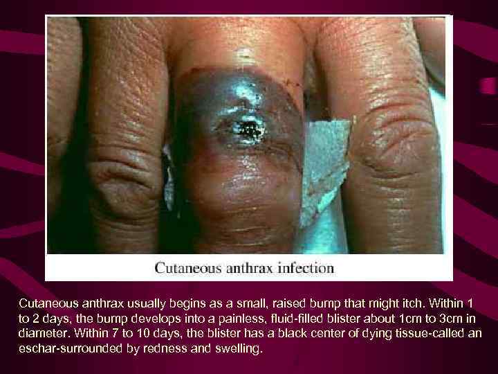 Cutaneous anthrax usually begins as a small, raised bump that might itch. Within 1