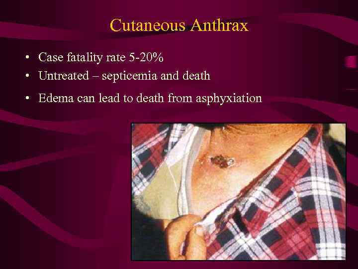 Cutaneous Anthrax • Case fatality rate 5 -20% • Untreated – septicemia and death