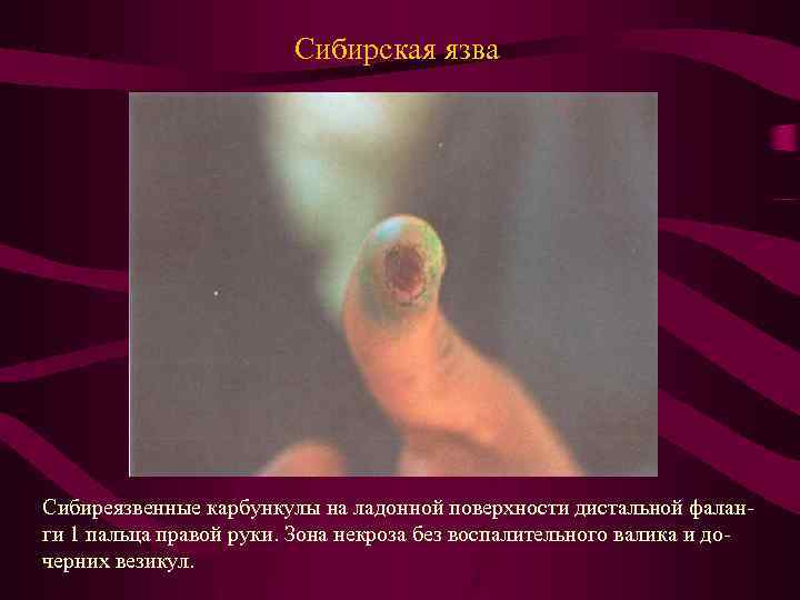 Сибирская язва Сибиреязвенные карбункулы на ладонной поверхности дистальной фаланги 1 пальца правой руки. Зона