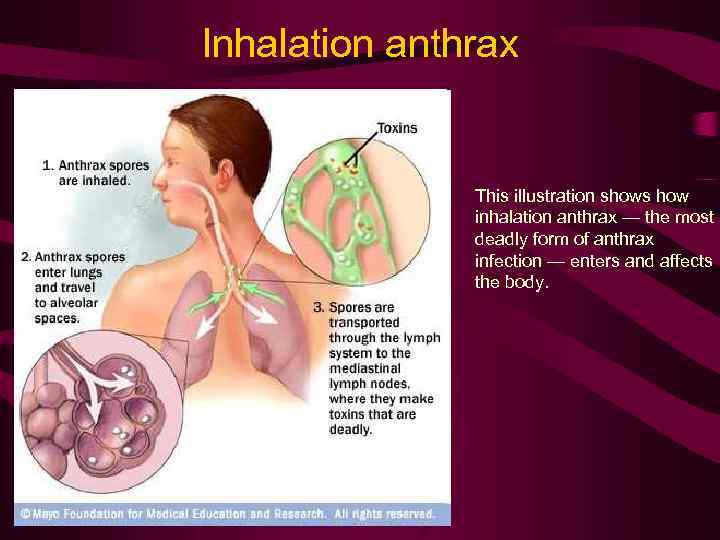Inhalation anthrax This illustration shows how inhalation anthrax — the most deadly form of
