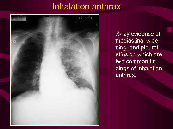 Inhalation anthrax X-ray evidence of mediastinal widening, and pleural effusion which are two common