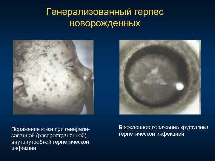 Генерализованный герпес новорожденных Поражение кожи при генерали зованной (распространенной) внутриутробной герпетической инфекции Врожденное поражение