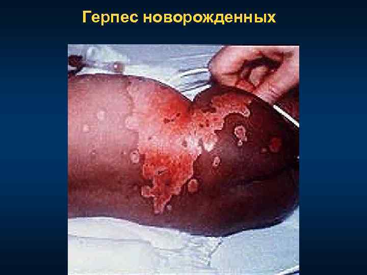 Герпес новорожденных 
