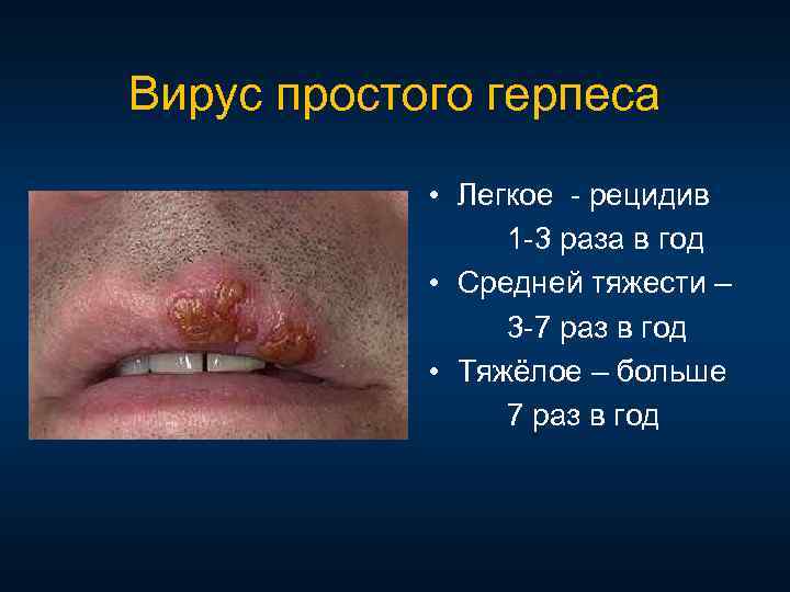Вирус простого герпеса • Легкое рецидив 1 3 раза в год • Средней тяжести
