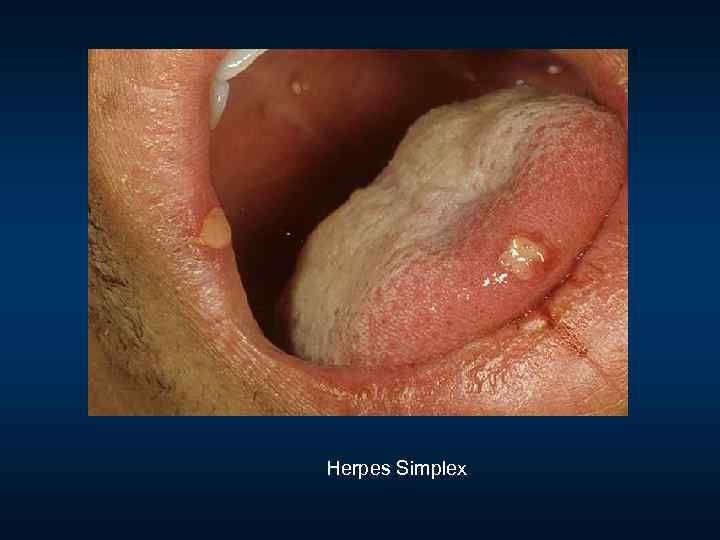 Herpes Simplex 