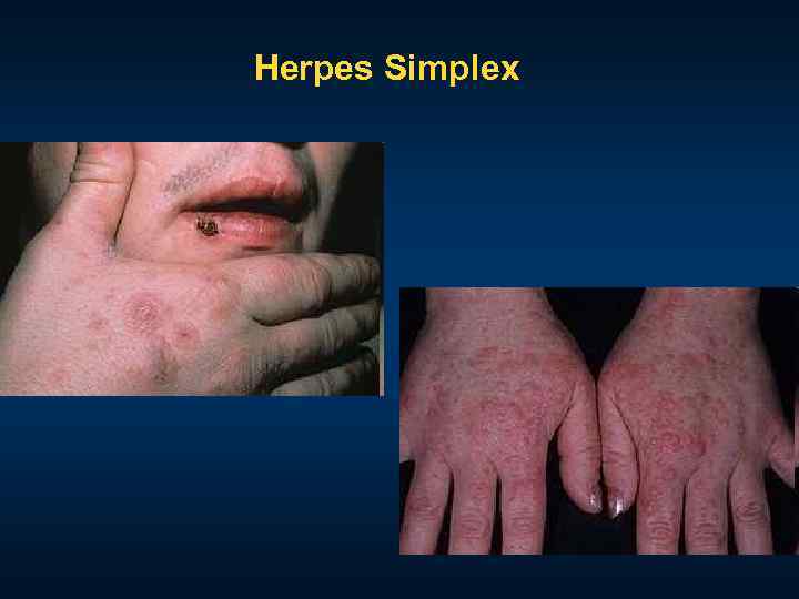 Herpes Simplex 