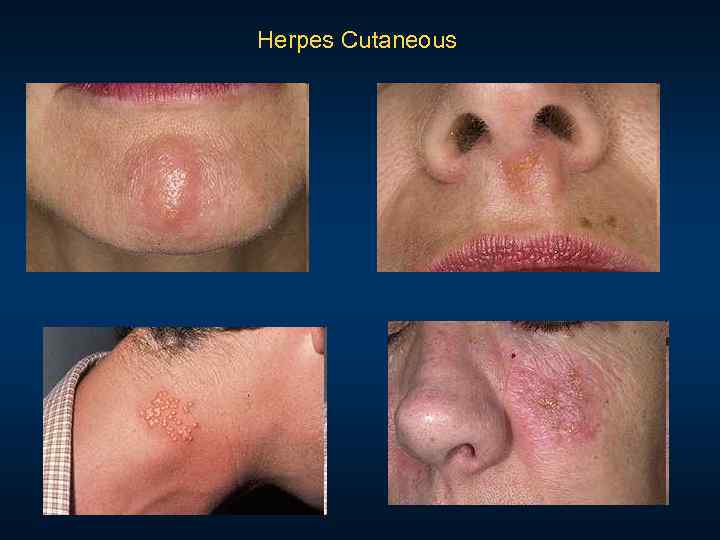 Herpes Cutaneous 