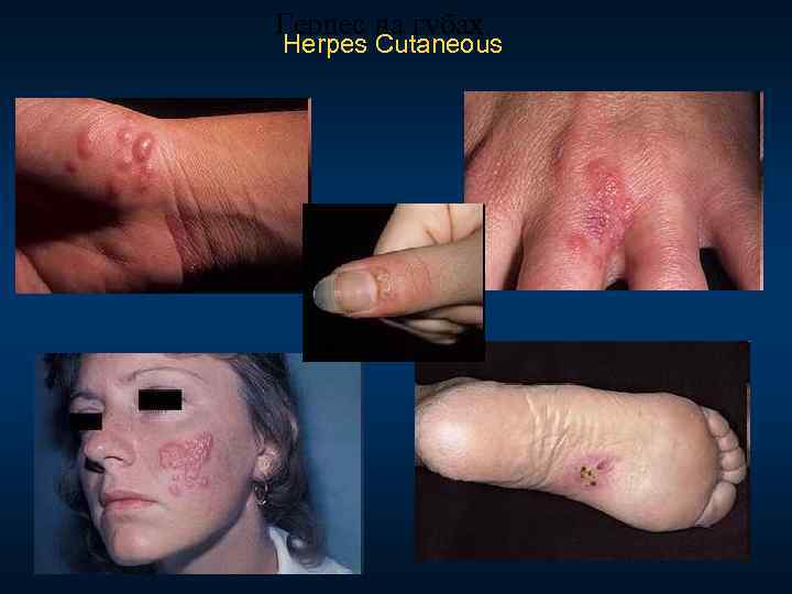 Герпес на губах. Herpes Cutaneous 