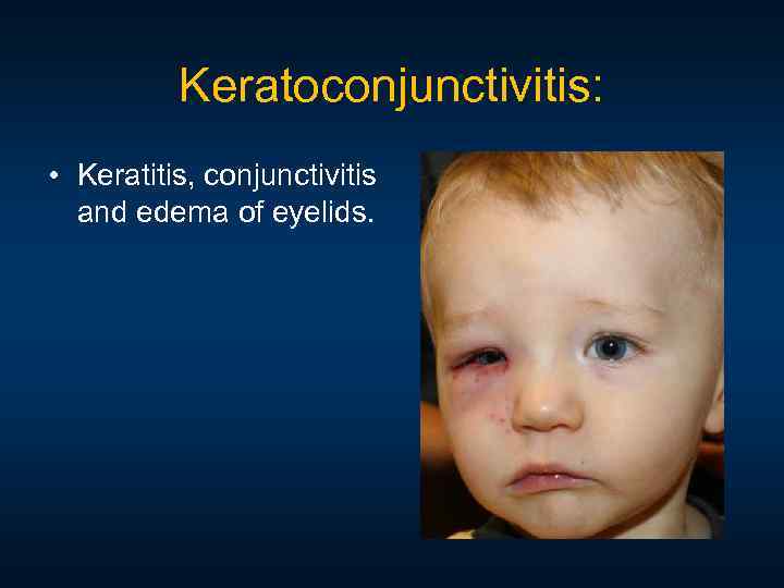 Keratoconjunctivitis: • Keratitis, conjunctivitis and edema of eyelids. 