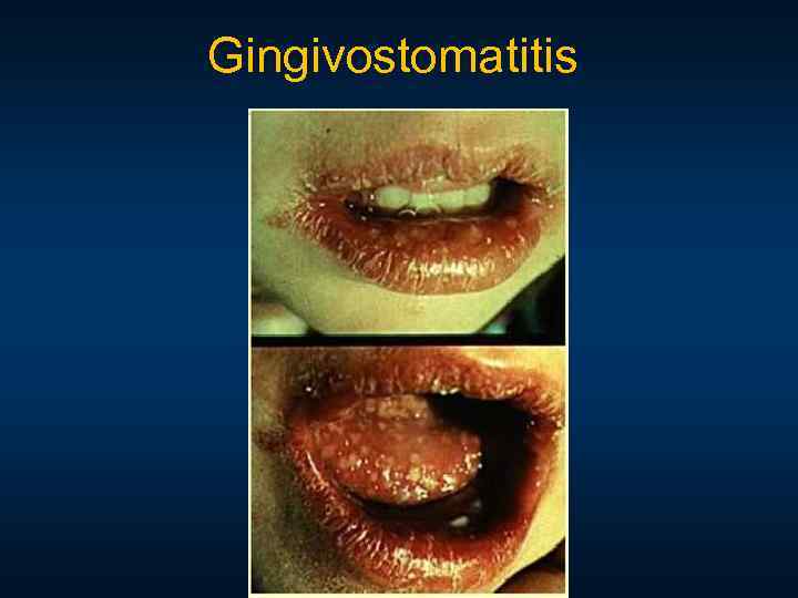 Gingivostomatitis 