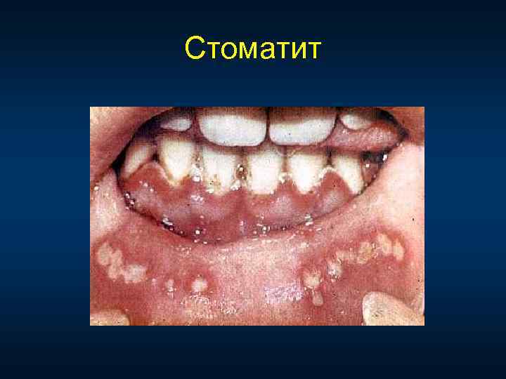 Стоматит 