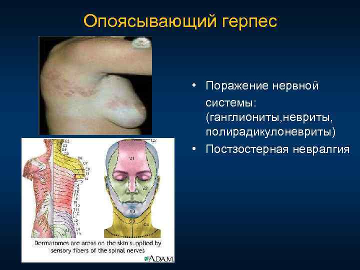 Опоясывающий герпес • Поражение нервной системы: (ганглиониты, невриты, полирадикулоневриты) • Постзостерная невралгия 