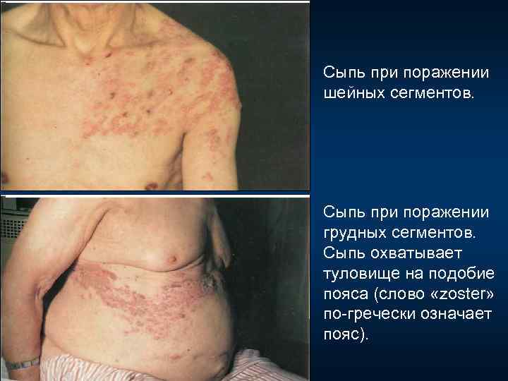 Сыпь при поражении шейных сегментов. Сыпь при поражении грудных сегментов. Сыпь охватывает туловище на