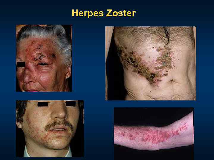 Herpes Zoster 