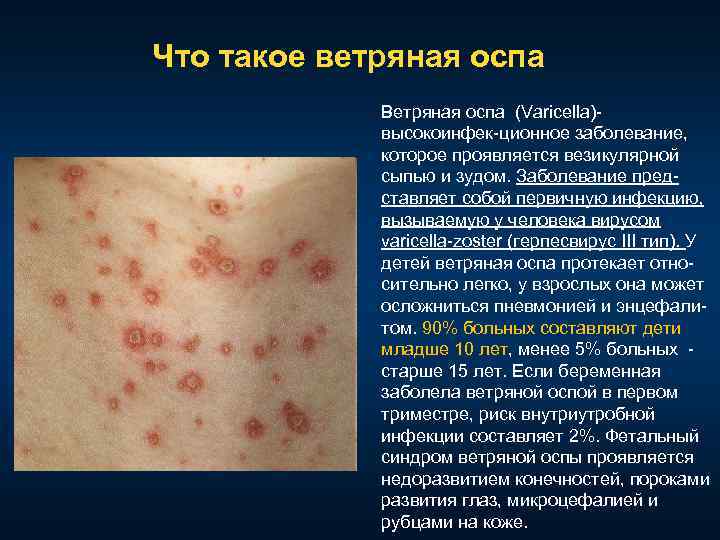 Что такое ветряная оспа Ветряная оспа (Varicella) высокоинфек ционное заболевание, которое проявляется везикулярной сыпью