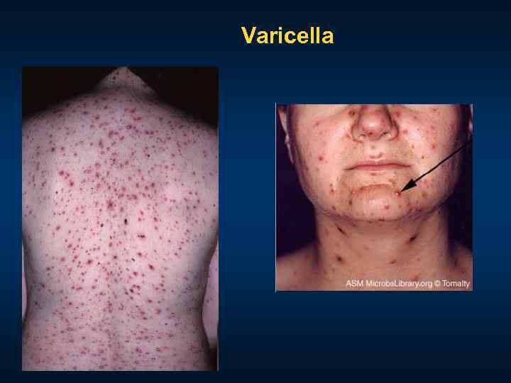 Varicella 