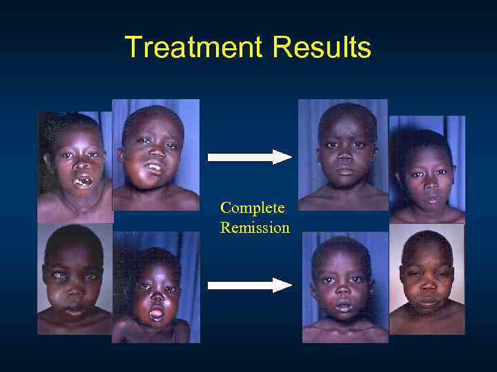 Treatment Results Complete Remission 