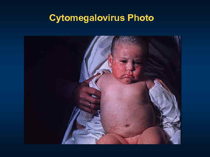 Cytomegalovirus Photo 