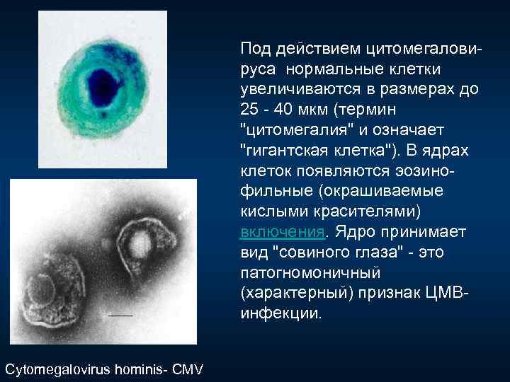 Под действием цитомегалови руса нормальные клетки увеличиваются в размерах до 25 40 мкм (термин