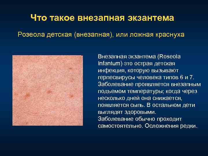 Что такое внезапная экзантема Розеола детская (внезапная), или ложная краснуха Внезапная экзантема (Roseola Infantum)