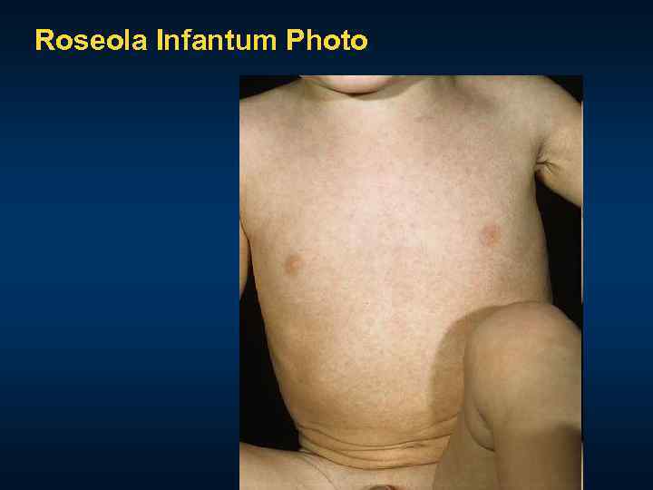 Roseola Infantum Photo 