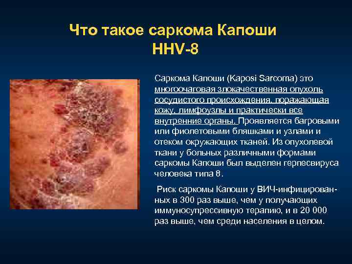 Что такое саркома Капоши HHV-8 Саркома Капоши (Kaposi Sarcoma) это многоочаговая злокачественная опухоль сосудистого