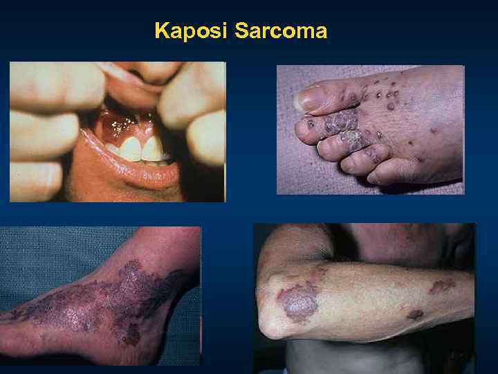 Kaposi Sarcoma 